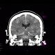 Coagulation necrosis of basal ganglia: CT - Computed tomography